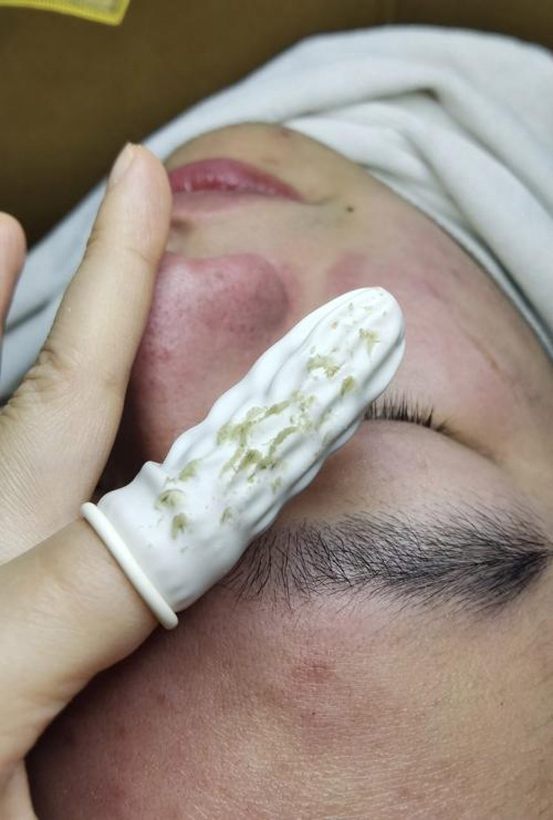 潍坊特色:如何在护肤圣地找到最适合的祛斑祛痘方法